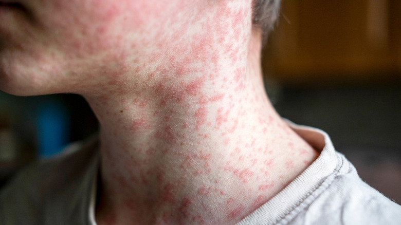 A young man with measles on his neck